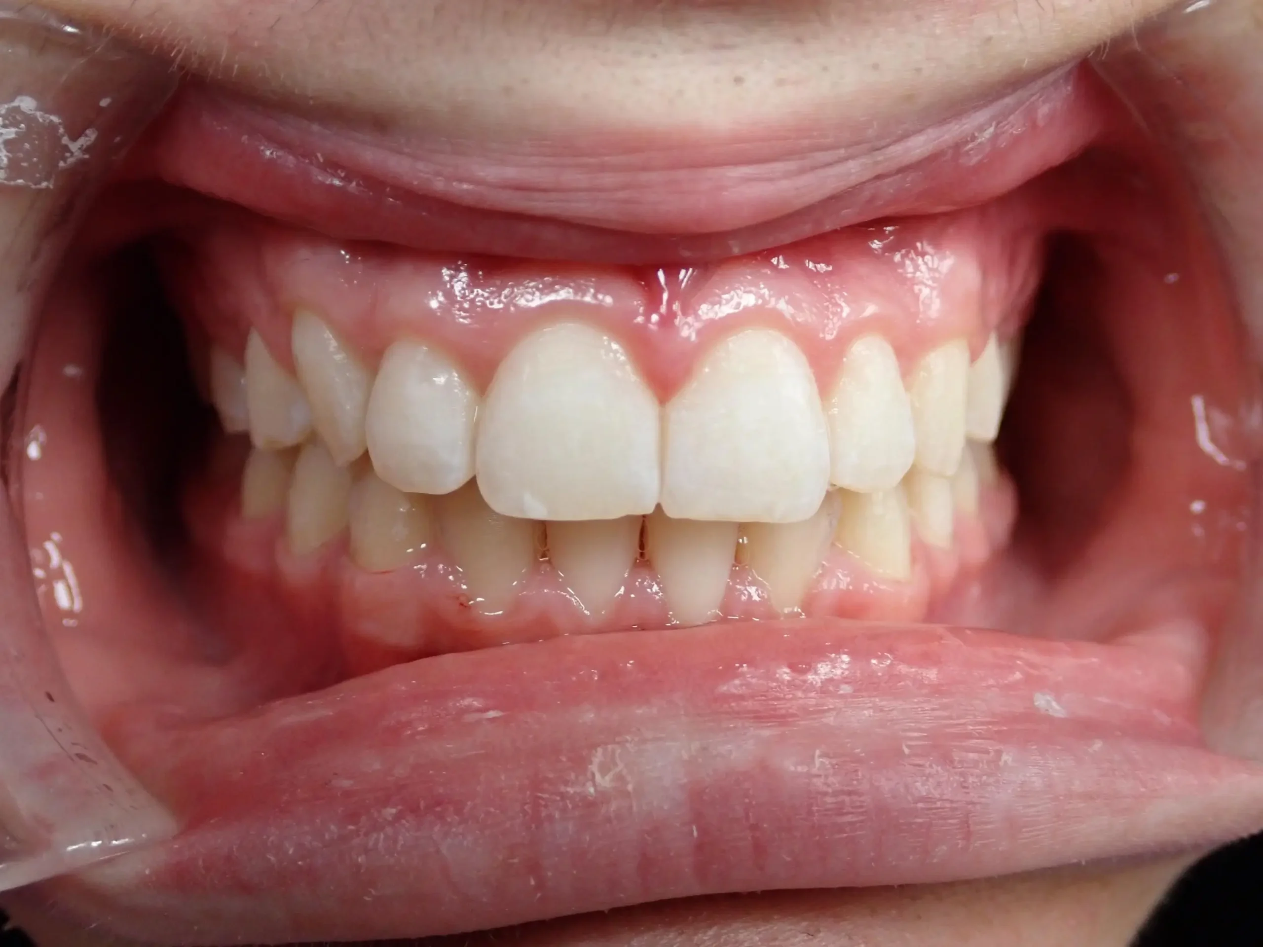 bowman, zachary after