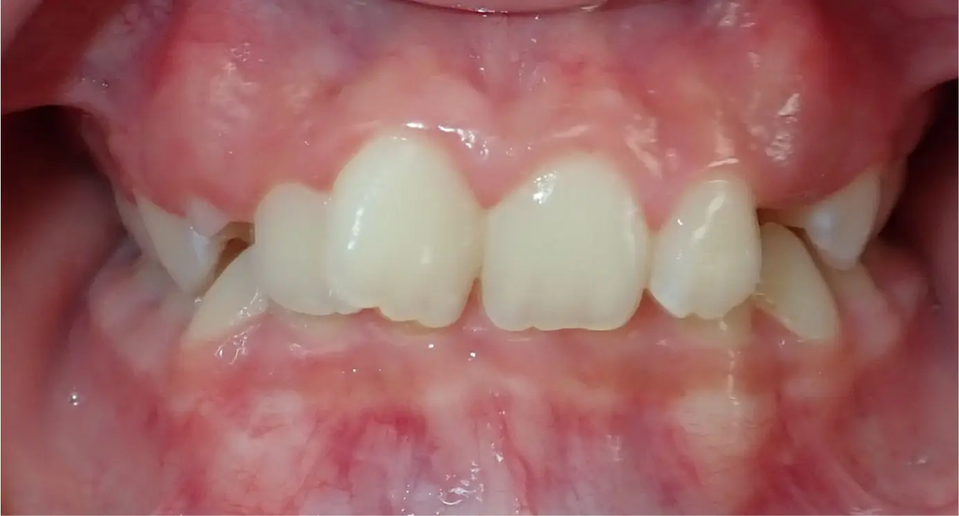 haley ortiz meija before