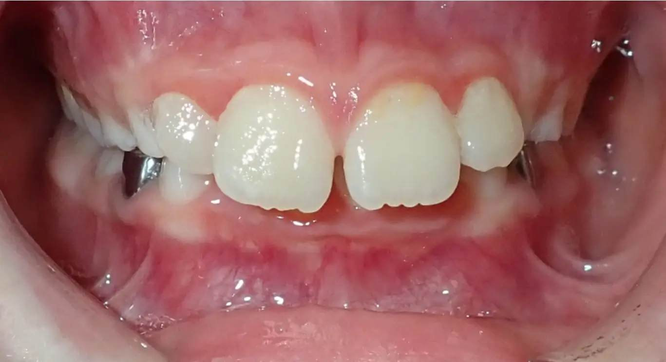 zachary bowman before