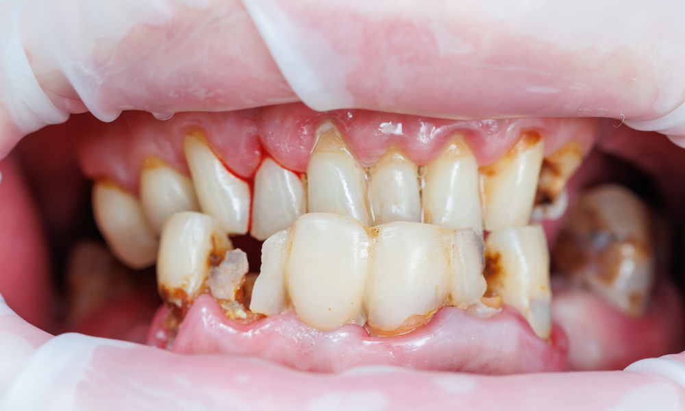 Severe tooth decay and cavities visible on multiple teeth with gum inflammation