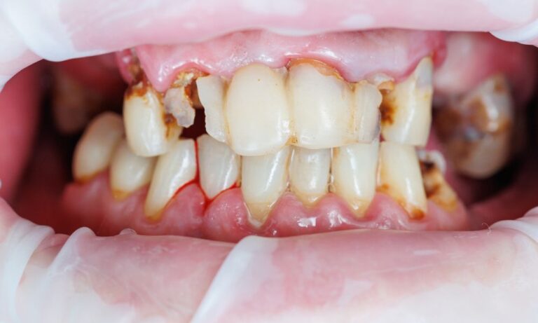 how long does it take for a cavity to form